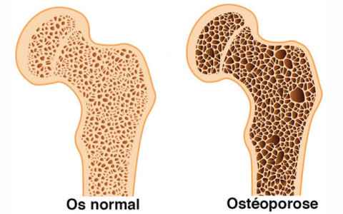 Limiter les risques d’ostéoporose en 10 astuces
